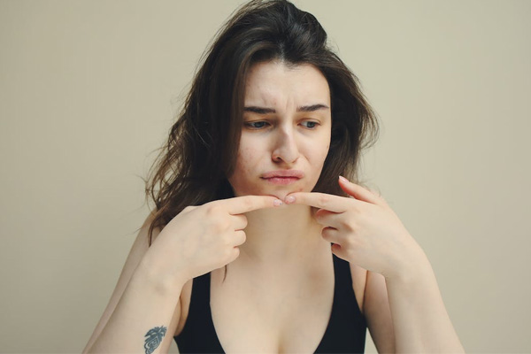 acne hormonal tratamento